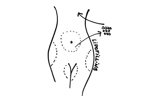 lipofilling ou injection de graisse pour reconstruction mammaire après mastectomie pour cancer du sein paris