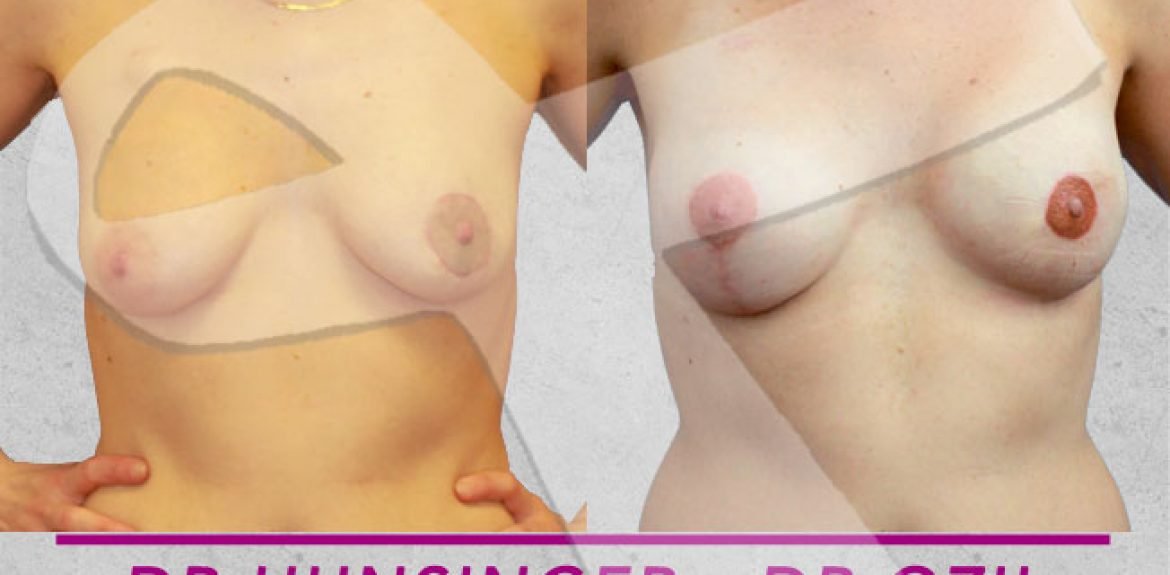 avant apres de reconstruction mammaire par prothèse mammaire après mastectomie